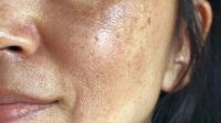 Manchas oscuras en la cara: ¿por qué salen y cómo eliminarlas?
